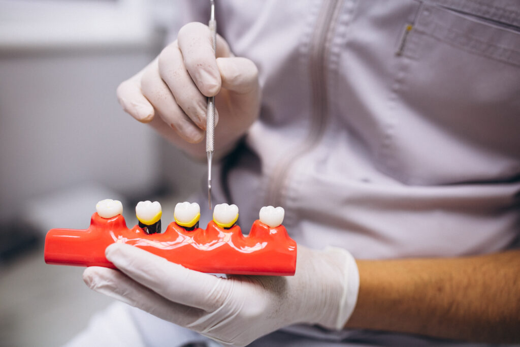 Dental Implants Placement