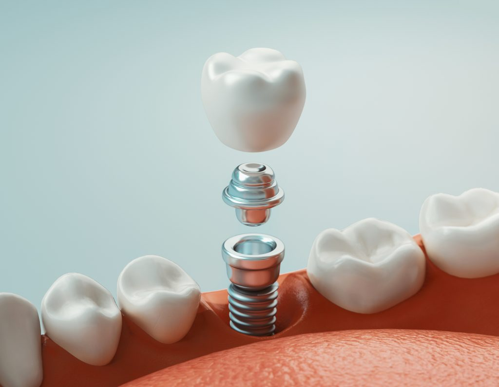 Implants treatment