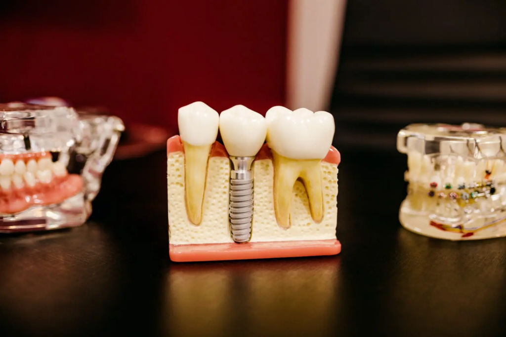 Dental implants procedure