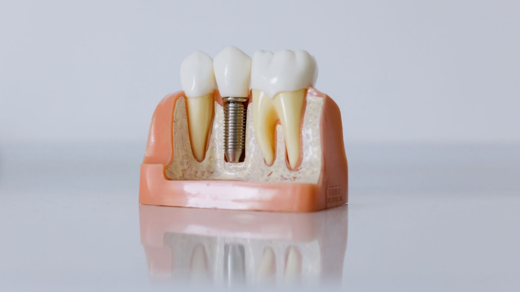 Implants placement