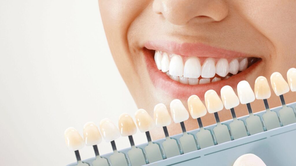 Teeth Whitening