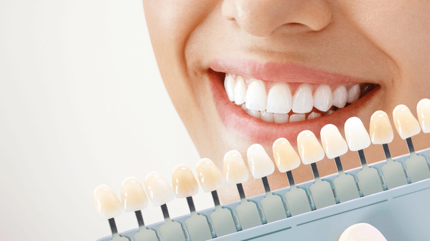 Teeth Whitening