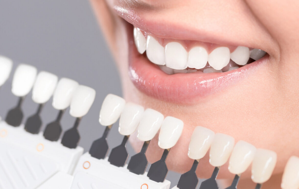 Dental Veneers Portland