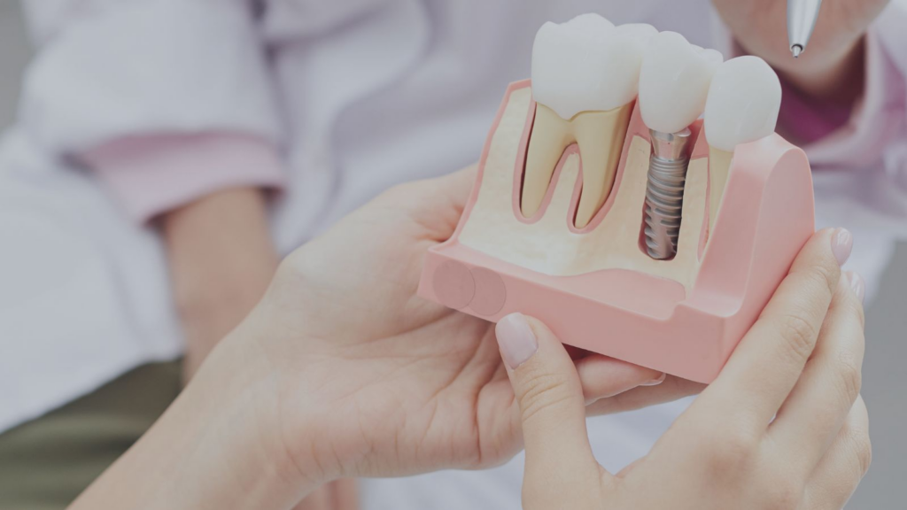 How Painful Are Dental Implants? 2 Cosmetic dental implants